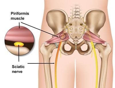 大名鼎鼎的梨狀肌與坐骨神經(圖/http://www.buffalobackandneckpt.com/2017/07/12/piriformis-syndrome-physical-therapy-can-help/)