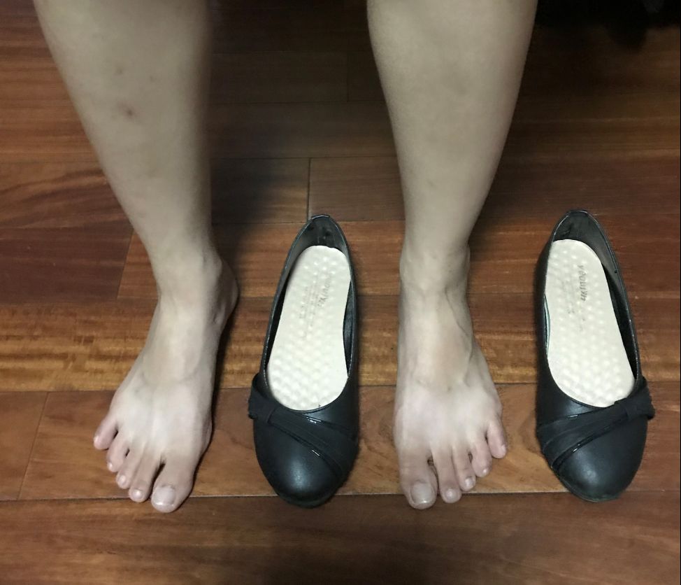 真的好多人這樣選鞋呀~腳還沒變形,但您注意到了嗎?腳趾顏色開始比較暗沉了。