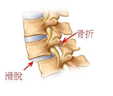 脊椎滑脫示意圖(圖片來源)
