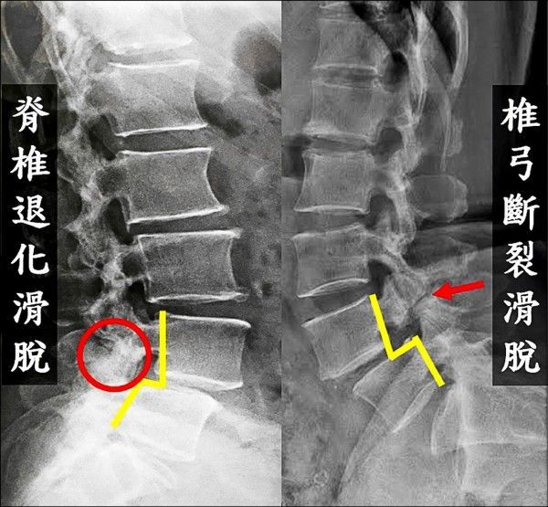 脊椎滑脫X光(圖片來源)