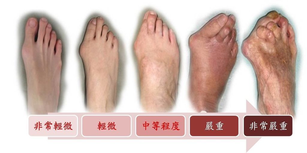 不同嚴重程度的拇趾外翻